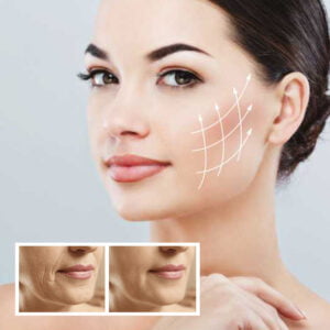 Beaubelle,Face Treatment,Collagen,wrinkle,skin tightening,Beauty Salon,Skin Treatment,Slimming