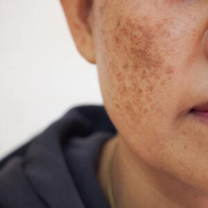 dull skin with pigment spots (classic wellness facial)