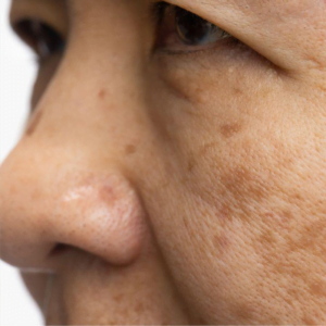 dull skin with pigment spots (classic wellness facial)